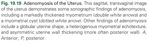 <p>Adenomyosis</p>