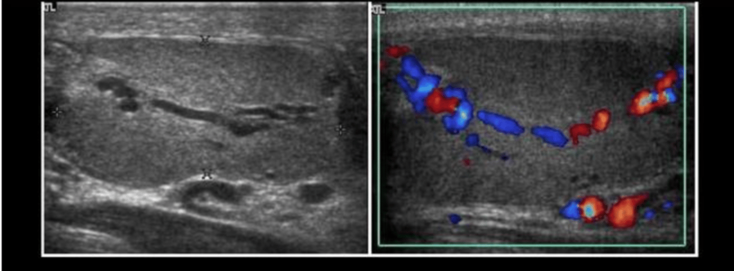 <p>Intratesticular varicocele</p>