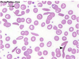 <p>Sickle Cell </p>