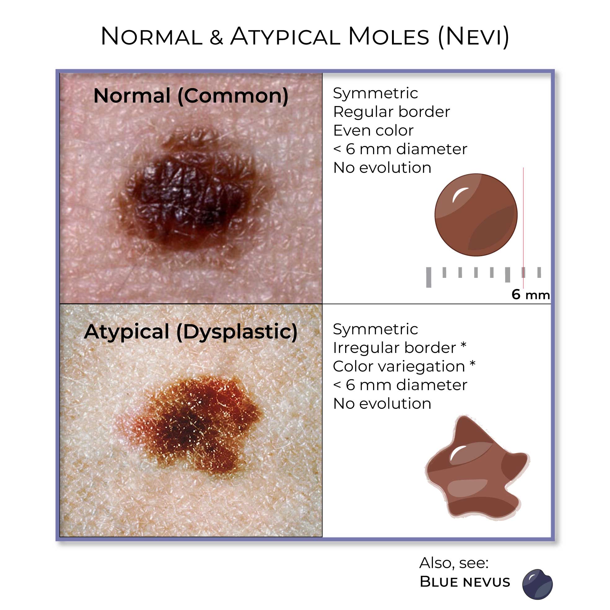 <p>A mole that has atypical features compared with an ordinary mole.</p>