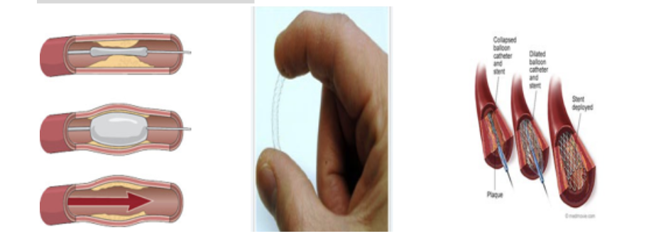 <p><span style="background-color: transparent;">–if clot of plaque</span></p>