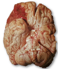 <p>What are early histologic changes after acute infarct?</p>