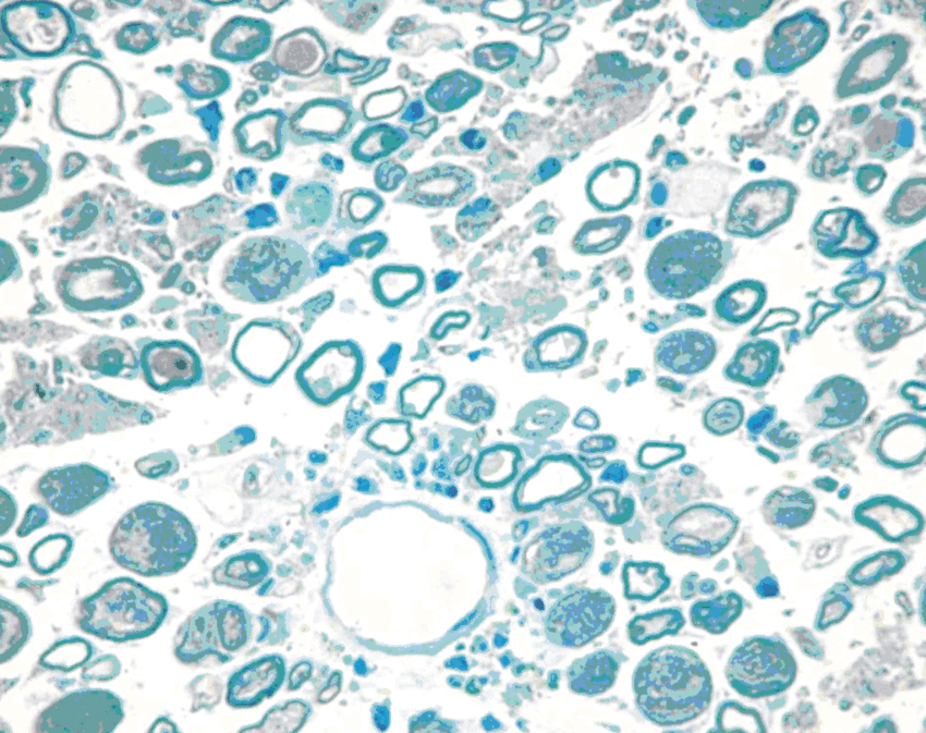 <p>WALLERIAN DEGENERATION</p>