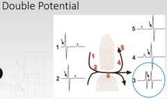 <p>3 shows the double potential; the high frequency signal in between resulting from the gap in the line of block</p>