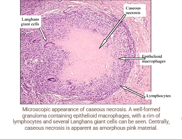 <ul><li><p>Immune system cannot successfully remove a foreign stimuli (e.g. tuberculosis). Forms granuloma </p></li></ul><p></p><ul><li><p><span style="color: red;">granuloma</span> with central necrosis, eosinophilia</p></li></ul><p></p>