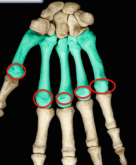 <p>Distal round portion</p>