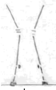 <ul><li><p>lateral deviation of limb distal to location of the deformity</p></li><li><p>carpal- distal portion of metacarpus deviates laterally &amp; distal portion of radius deviates medially</p></li><li><p>usually toed out</p></li></ul><p></p>