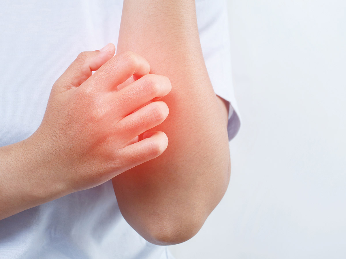 <p>The most common symptom of atopic dermatitis is intense itchiness, which can lead to scratching and further skin irritation. </p>