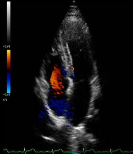 <p>What color Doppler artifact is demonstrated?</p>