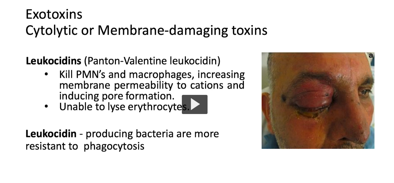 <ul><li><p><strong>“leuko-”</strong> → from Greek <em>leukos</em> = <strong>“white”</strong></p></li><li><p><strong>“-cidin”</strong> → from Latin <em>caedere</em> = <strong>“to kill”</strong></p></li></ul><p><span data-name="point_right" data-type="emoji">👉</span> <strong>Leukocidin = “white cell killer”</strong></p><div data-type="horizontalRule"><hr></div><p><strong>Definition</strong></p><p><strong>Leukocidins</strong> are <strong>exotoxins</strong> produced by <em>Staphylococcus aureus</em> that:</p><ul><li><p><strong>Kill white blood cells</strong> (especially neutrophils and macrophages)</p></li><li><p>Work by:</p><ul><li><p><strong>Forming pores in cell membranes</strong></p></li><li><p>Increasing permeability → cells swell and burst</p></li></ul></li></ul><p></p>