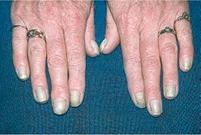 <p>Name this + its etiology</p>