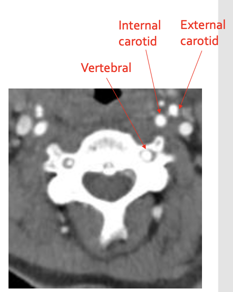 <p><strong>External carotid</strong></p>