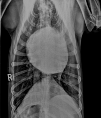 <p>Left sided enlargement</p>