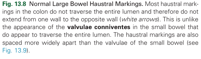 <p>Normal Large Bowel Haustral Markings.</p>