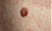 <p>compound pigmented nevi*</p>