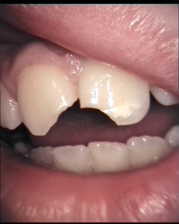 <p>to damage the edge of something by breaking off a small piece</p><p></p><p><strong>Common collocations</strong></p><ul><li><p>___ed cup</p></li><li><p>___ed plate</p></li><li><p>___ed tooth</p></li><li><p>___ the edge</p></li></ul><p></p><p><em>I accidentally ____ my favourite mug.</em></p><p><em>The plate is ____.</em></p><p><em>Be careful not to ____ the table.</em></p>