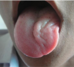 <p>paralysis and atrophy of the tongue </p><p>deviates towards paralysed side.</p>