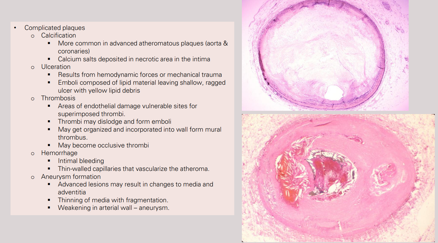 <p><span style="background-color: transparent; font-family: "Times New Roman", serif;"><strong>Complicated Plaque:</strong> Can show <strong>calcification</strong>, <strong>ulceration</strong>, or <strong>thrombosis</strong> (the trigger for an MI).</span></p>