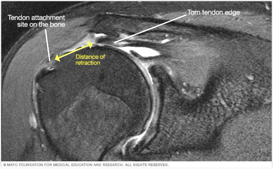 <p>rotator cuff treatment</p>