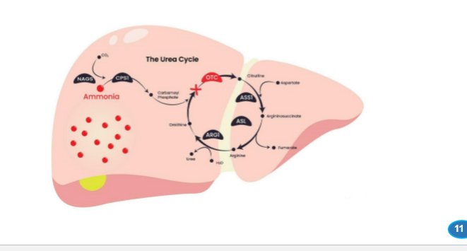 <p>What is the result of <strong>ornithine transcarbamylase (OTC) </strong>deficiency in which the enzyme responsible for <strong>combining carbamoyl phosphate with ornithine to form citrulline</strong> is defective</p>