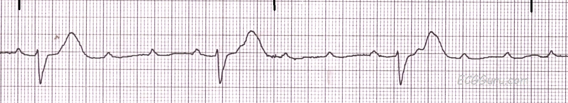 <p>Rate: separate rate for underlying and escape rhythm</p><p>Regularity: regular, but P and QRS rates are different </p><p>If P’s and Q’s don’t agree</p>