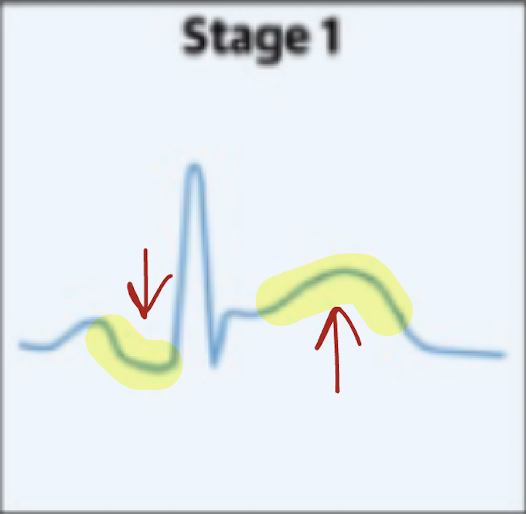 <p>ST elevation and PR depression</p>