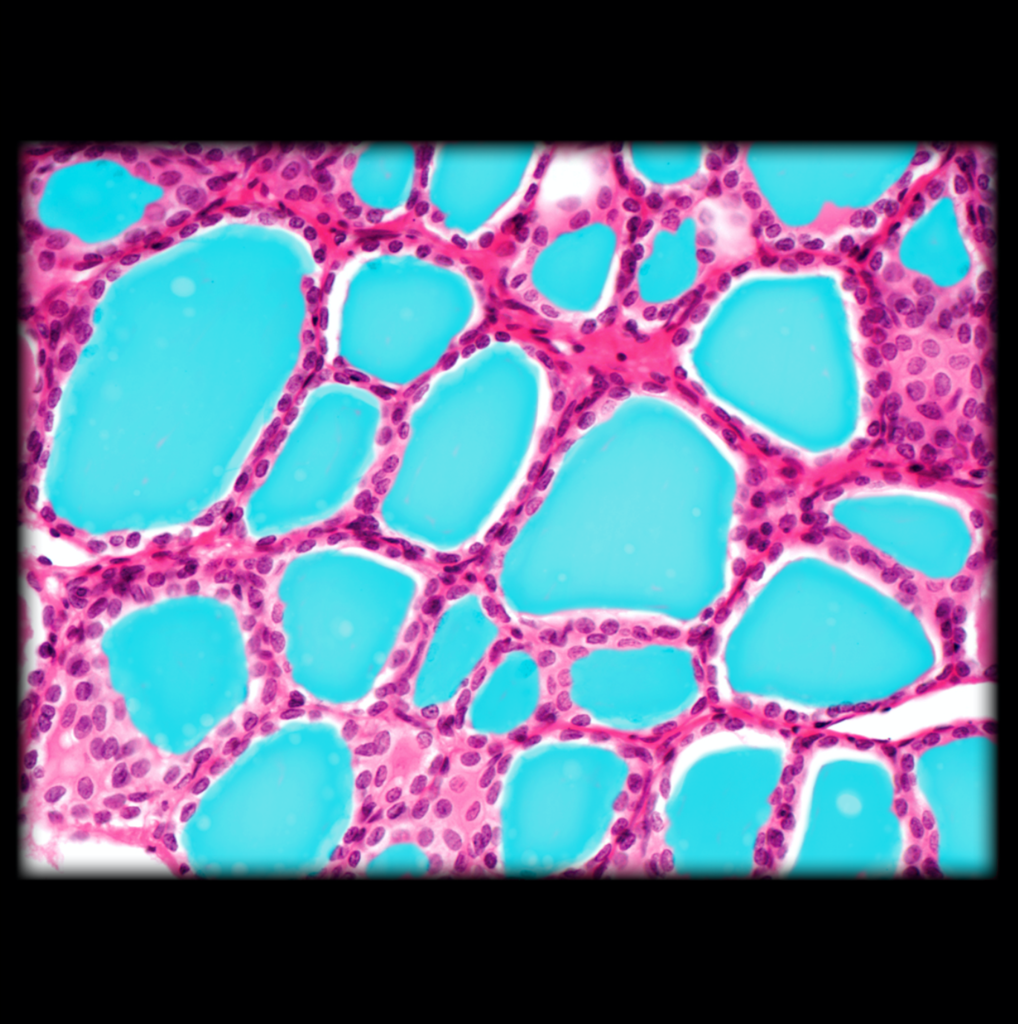 <p>Follicular Colloid of Thyroid Gland</p>