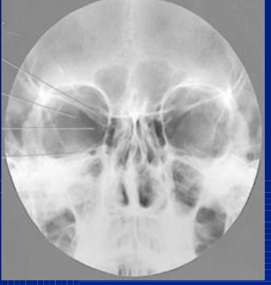 <p>pet ridges in lower third of orbits </p><p>pet ridges in septum</p>