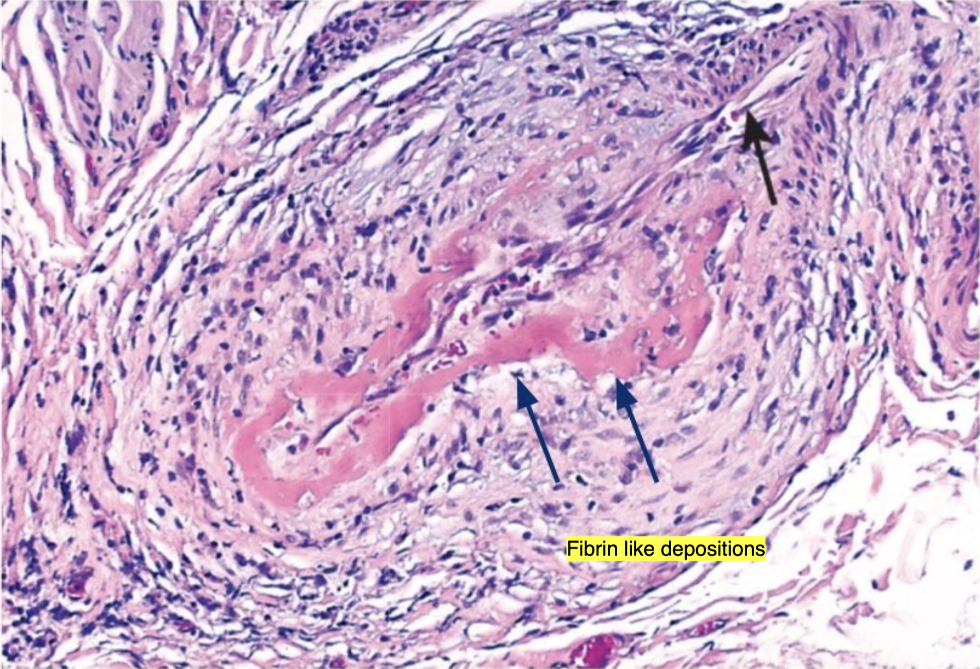 <p>Fibrin-like deposition of pink (eosinophilic) material or debris after vascular cell death(endothelial cell death); caused by immune complex deposition (or chemical damage)</p>