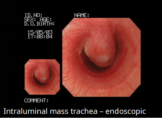 <ul><li><p>physical location of narrowing is constant</p></li><li><p>intraluminal or extraluminal</p></li><li><p>inspiratory and expiratory airflow reduced</p></li></ul><p></p>