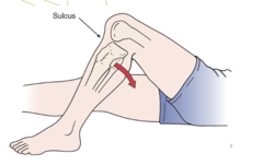 <p>Supine, hip flexed 45°, knee flexed 90°; gravity-induced tibial drop indicates PCL tear.</p>
