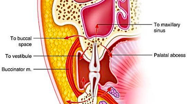 <p>begins in periapical/ periodontal area → spreads in all directions favoring the path of least resistance → gradually erodes cancellous bone toward facial or lingual cortices → once through cortical bone, it spreads to fascial spaces (fascial spaces are not actual spaces but become created when invaded by infection)</p>