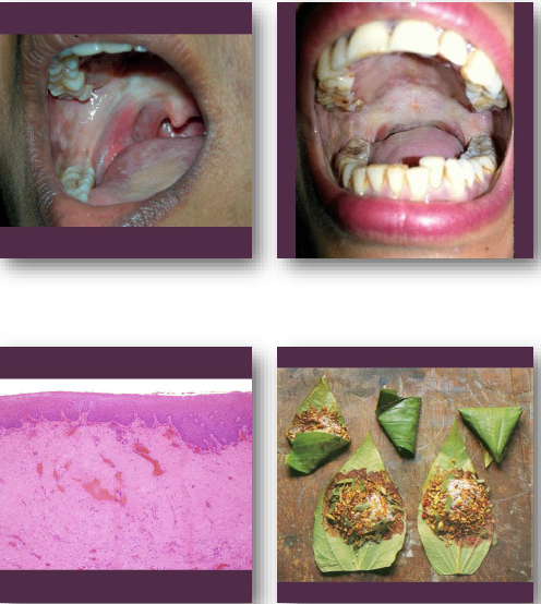 <p><strong>•Eliminate areca nut and irritant habits</strong></p><p>•Nutritional support and medical therapy</p><p>•Physical therapy to improve mouth opening</p><p><strong>•Requires close monitoring for malignancy</strong></p><p>•Significant transformation risk over time</p>