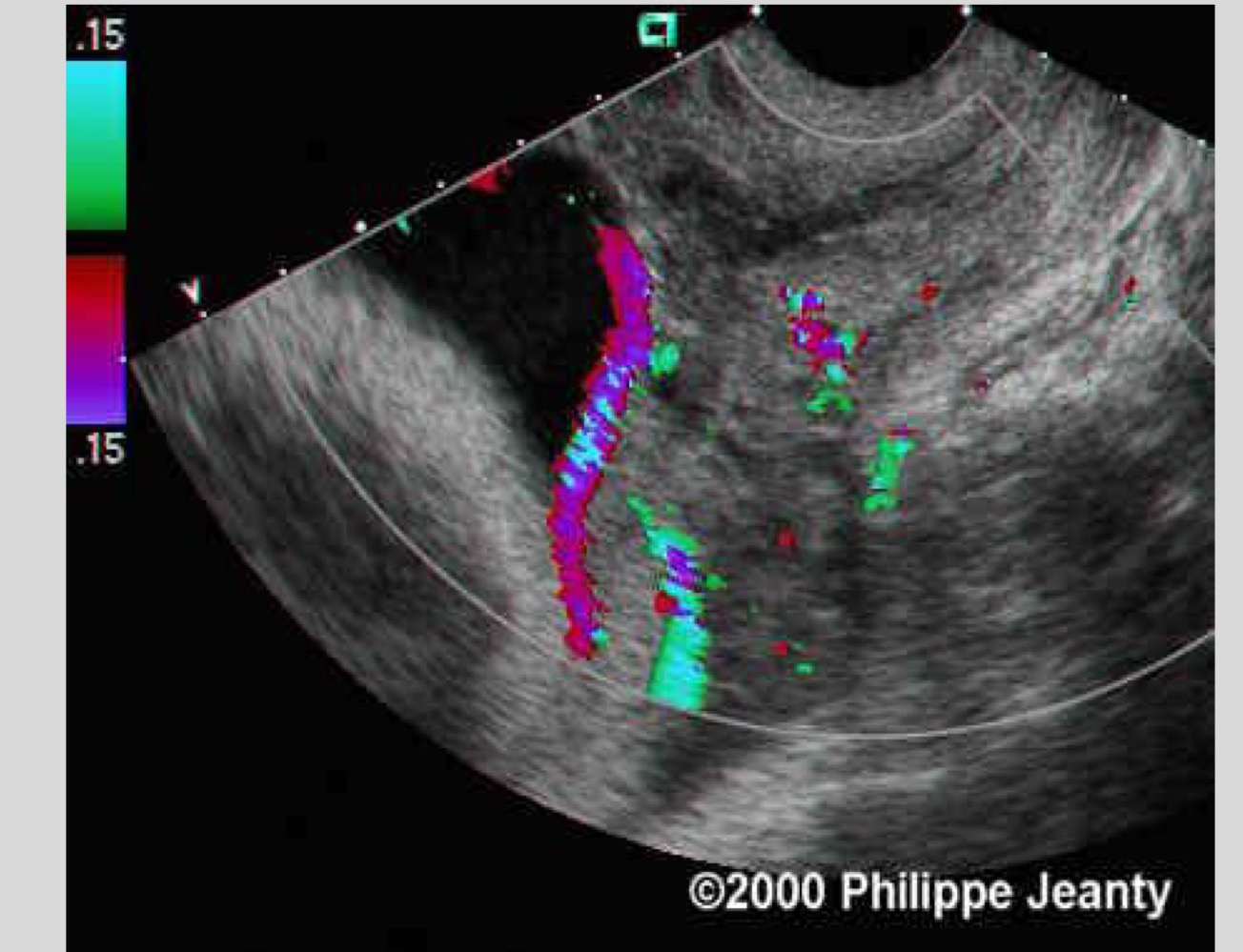 <p>Fetal vessels pass below the presenting part near the cervix</p>