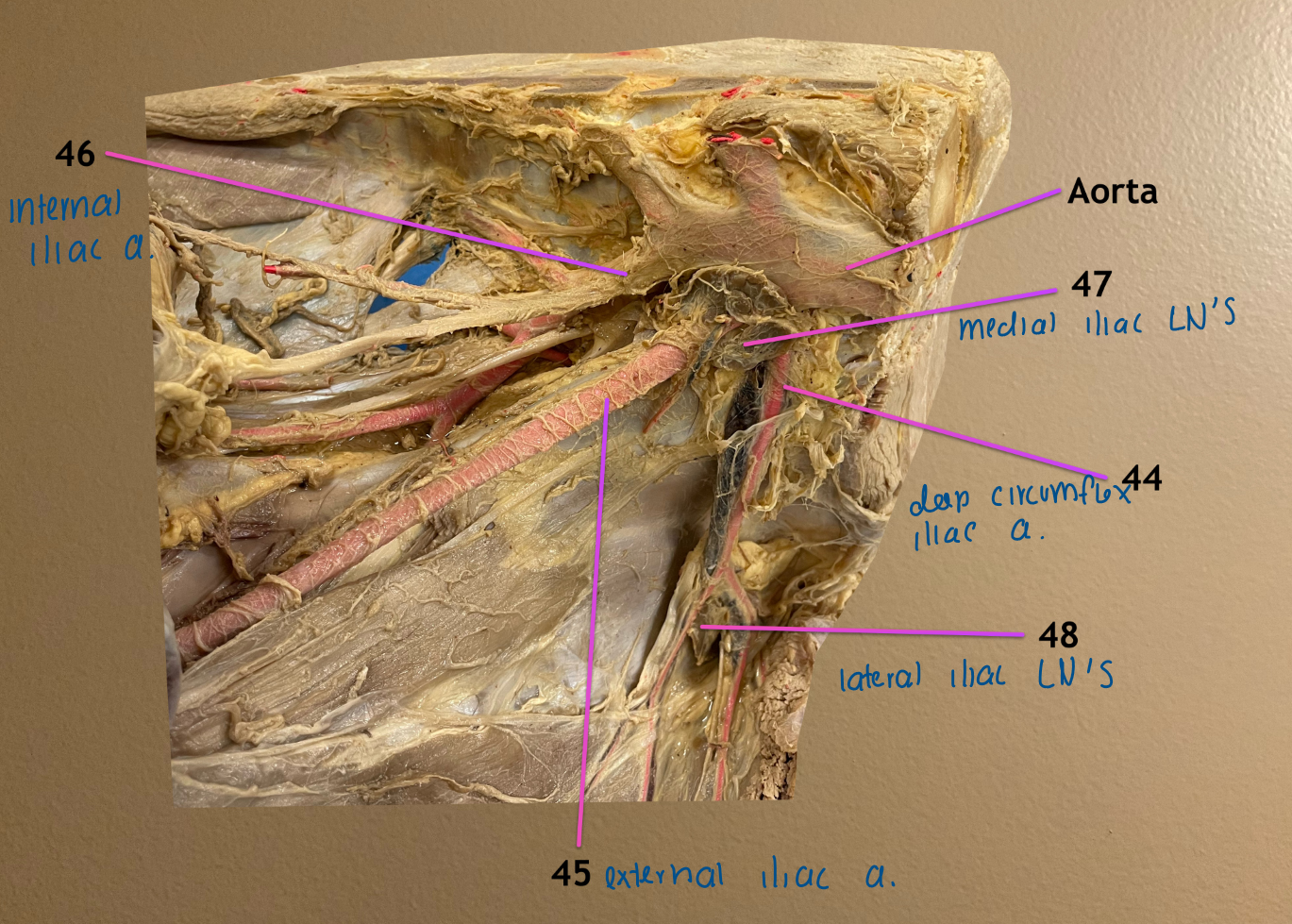 <ol start="44"><li><p>deep circumflex iliac a.</p></li><li><p>external iliac a.</p></li><li><p>internal iliac a.</p></li><li><p>medial iliac lymph nodes: located at origin of 44</p></li><li><p>lateral iliac lymph nodes: located where 44 bifurcates </p></li></ol><p></p>
