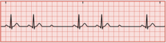 <p>Also known as Mobitz II. It is the classic form of heart block. A P wave is present with no QRS complex or T wave, the AV node has selectively blocked specific impulses</p>