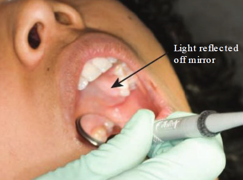 <ul><li><p>Use of mirror surface to reflect light onto tooth surface in dark areas of the mouth </p></li></ul><p></p>