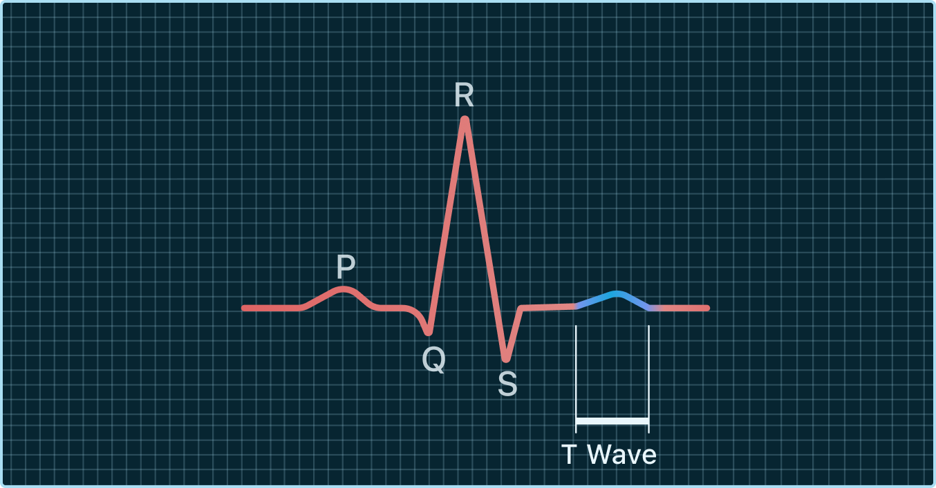 <p>T Waves</p>