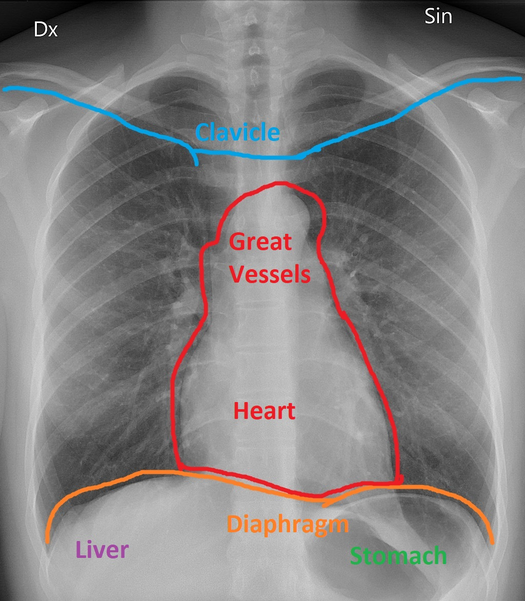 <p>The accompanying image is a chest X-ray with the outline of the heart as it sits in the mediastinum resting atop the diaphragm. Which heart chamber forms the RIGHT border of human hearts?</p>