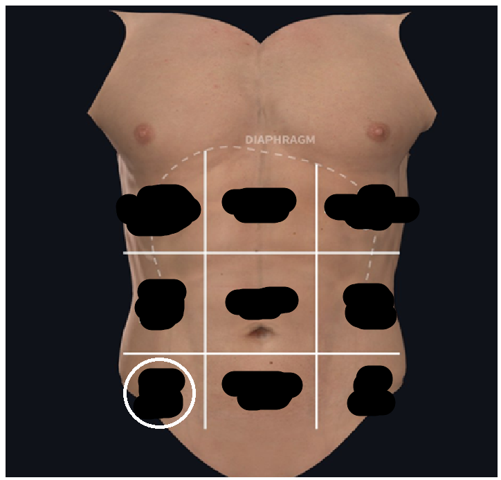 <ul><li><p><span style="background-color: transparent;">Lateral to hypogastric&nbsp;</span></p></li><li><p><span style="background-color: transparent;">At the groin</span></p></li></ul><p></p>
