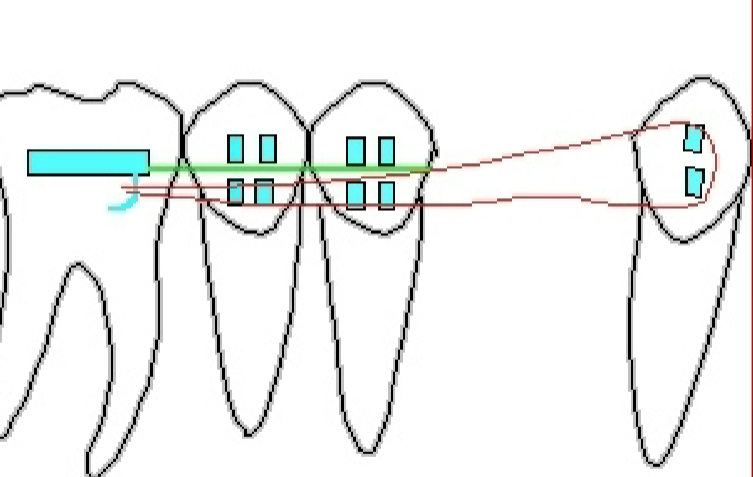 <p>ID the elastics class:</p><p>- Connects two teeth in the same arch</p>
