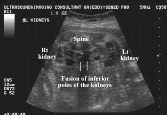 <ul><li><p>bridge of tissue connecting the lower poles</p></li><li><p>if spine down, connecting isthmus may be seen anterior to AO</p></li></ul><p>**coronal view is ideal</p>