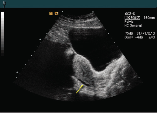 <p>3. In Figure 16-15, what does the arrow indicate?</p><p>a. Fluid within the rectouterine pouch</p><p>b. Fluid within the vesicouterine pouch</p><p>c. Fluid within the space of Retzius</p><p>d. Fluid within the anterior cul-de-sac</p>