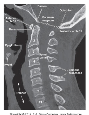 <p>What spinal structures are best visualized in the sagittal CT plane?</p>