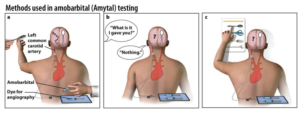 <ul><li><p>Intracarotid sodium amobarbital procedure (ISAP) is used to determine which side of the brain controls language function and how important each side of the brain is for memory function.</p></li><li><p>Amobarbital is administered to the left hemisphere through the carotid artery, anesthetizing that hemisphere.</p></li></ul><p></p>