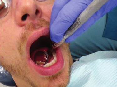 <ul><li><p>3 o’ clock position</p></li><li><p>Rest finger on left side of patient’s face</p></li><li><p>Use mirror to gently move the tongue away from teeth. Use indirect vision to view distal and lingual surfaces.</p></li></ul><p></p><p><strong>Avoid pressing down against floor of mouth with mirror head </strong></p><p></p>