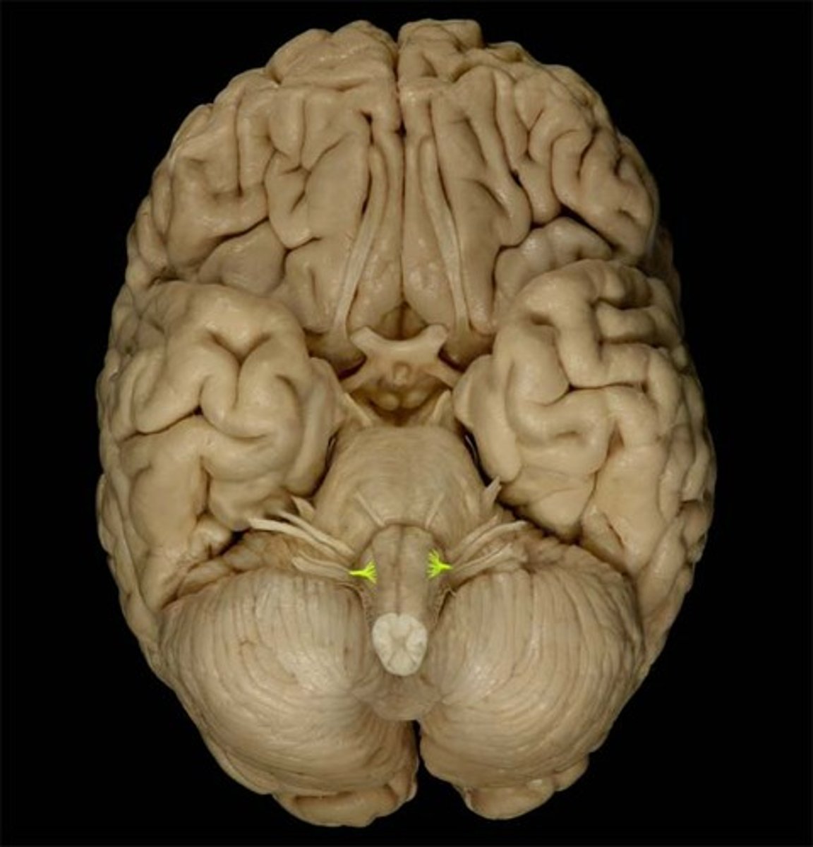 <p>Name:</p><p>Hypoglossal</p><p>Sensory or Motor:</p><p>Motor</p><p>Key Functions:</p><p>Tongue movement</p><p>Symptoms:</p><p>Tongue deviates toward lesion</p><p>Clinical: </p><p>Atrophy, fasciculations</p>