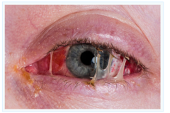 <p>+purulent eye discharge</p><p>+ redness</p><p>+/- light sensitivity</p>
