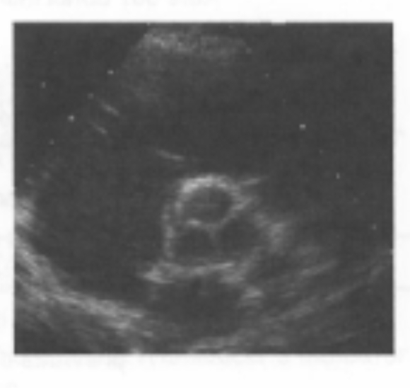 <p><span>AoV – all 3 aortic valve leaflets: </span><br><span><strong>RCC, LCC and NCC    </strong></span></p><p><span><strong>Systole</strong>: the <strong>aortic leaflets open</strong></span><br><span>to a near circular <strong>(triangular)</strong></span><strong><br></strong><span><strong>orifice.  </strong></span></p><p><span><strong>Diastole</strong>: the “Y” shaped</span><br><span>coaptation lines of the leaflets is</span><br><span>seen <strong>(Mercedes sign).</strong></span></p>