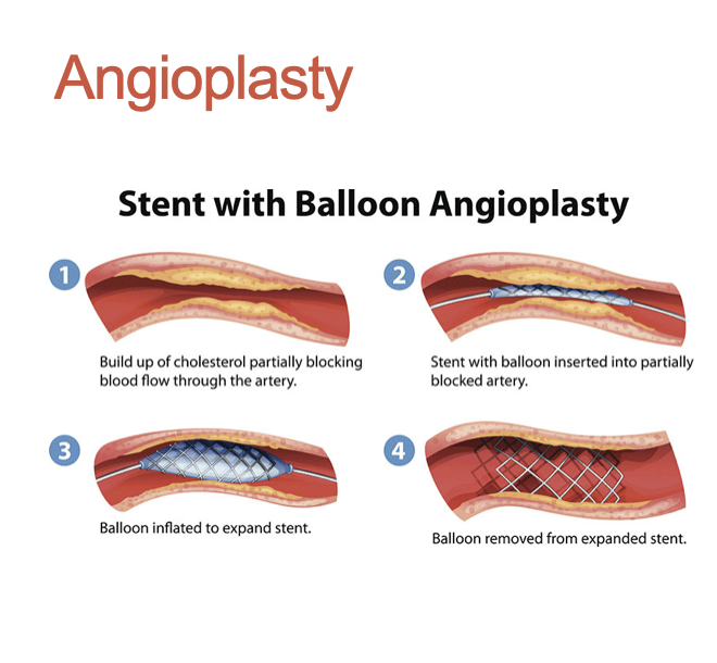 <p>What is Angioplasty? What/how does it treat?</p>